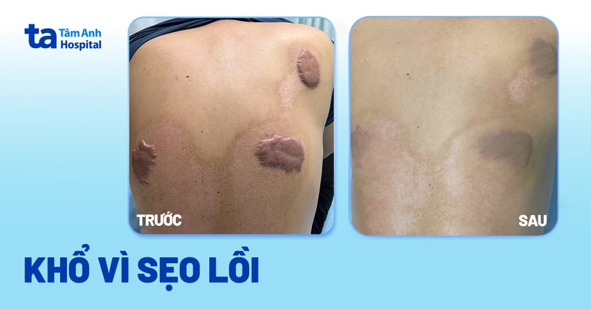 khổ vì sẹo lồi