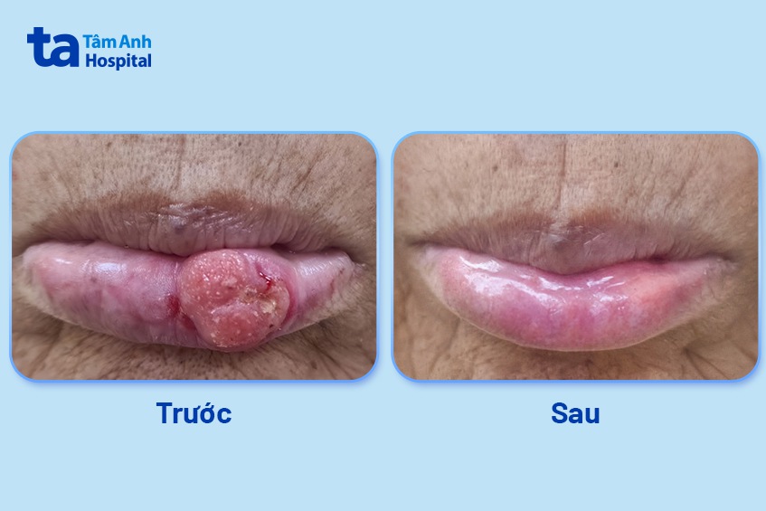 khối u của người phụ nữ