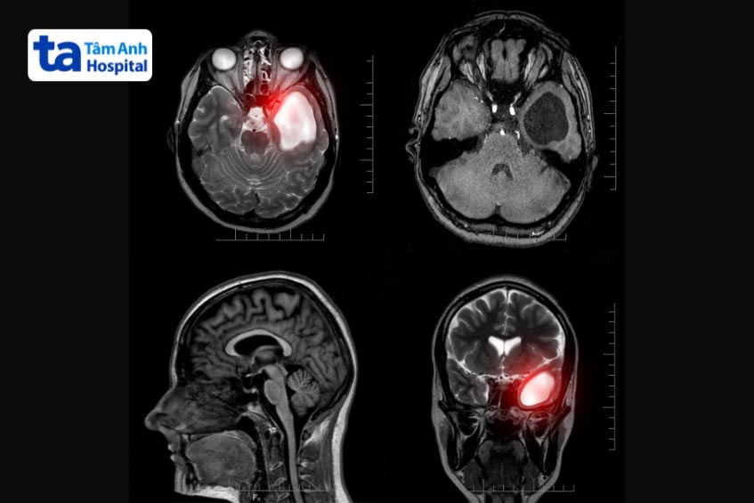 khối u nang màng nhện