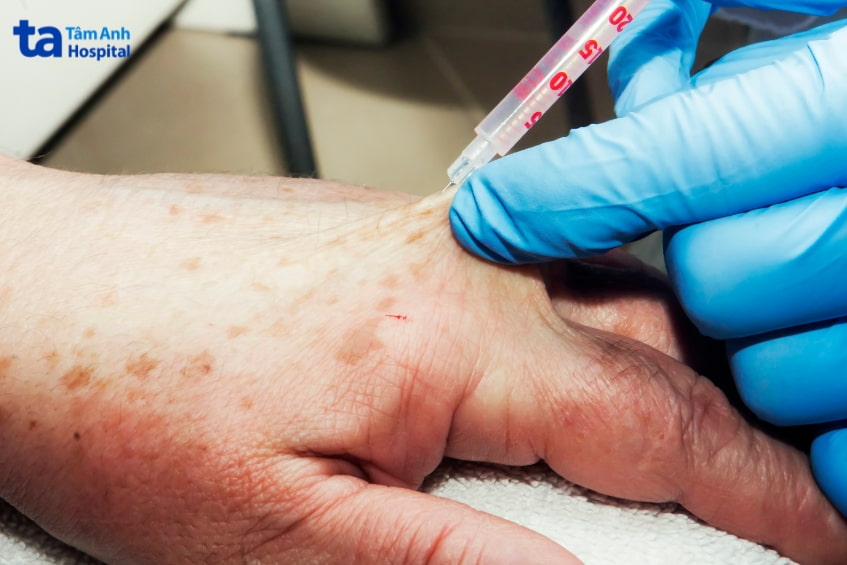 kỹ thuật gây tê tại chỗ