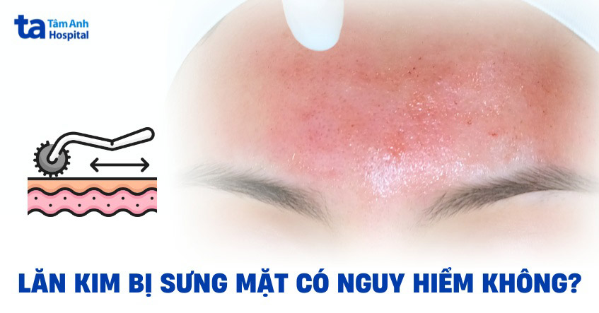 Nguyên nhân lăn kim bị sưng mặt và cách xử lý hiệu quả