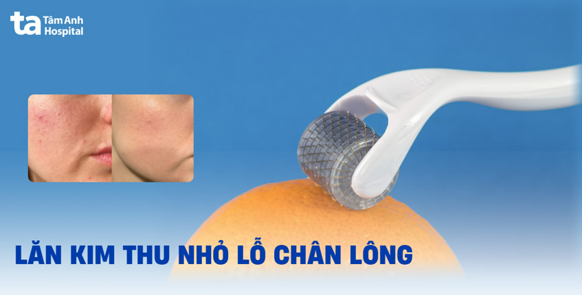 Thực hư lăn kim thu nhỏ lỗ chân lông có hiệu quả không?