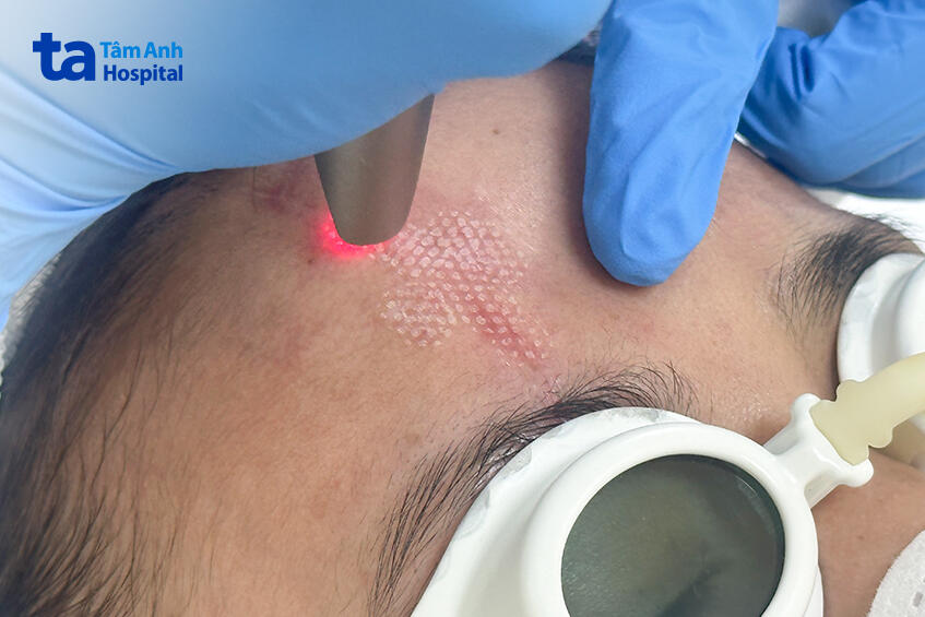 laser tạo nhiệt vi điểm tăng sinh mô