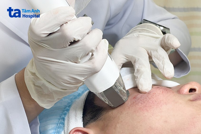laser trị sẹo mụn cho bệnh nhân