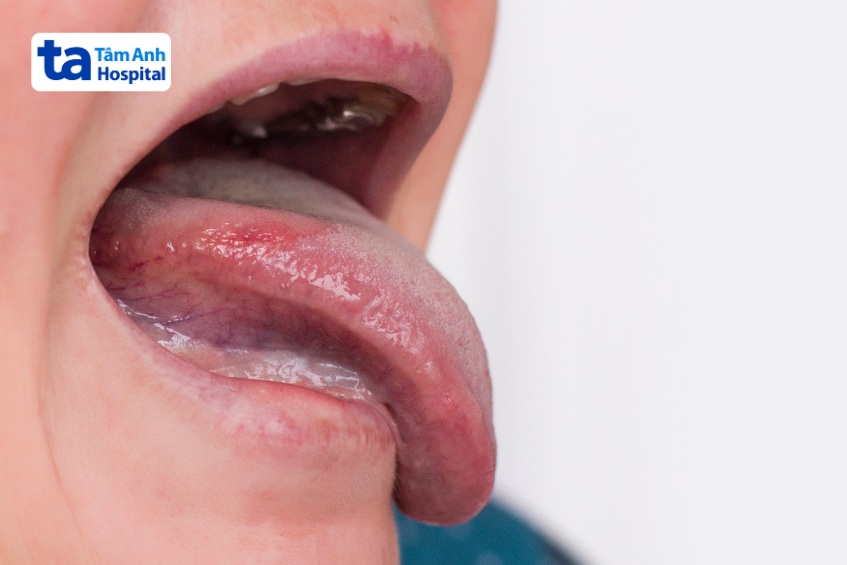 liệt dây thần kinh số 9 ảnh hưởng lưỡi