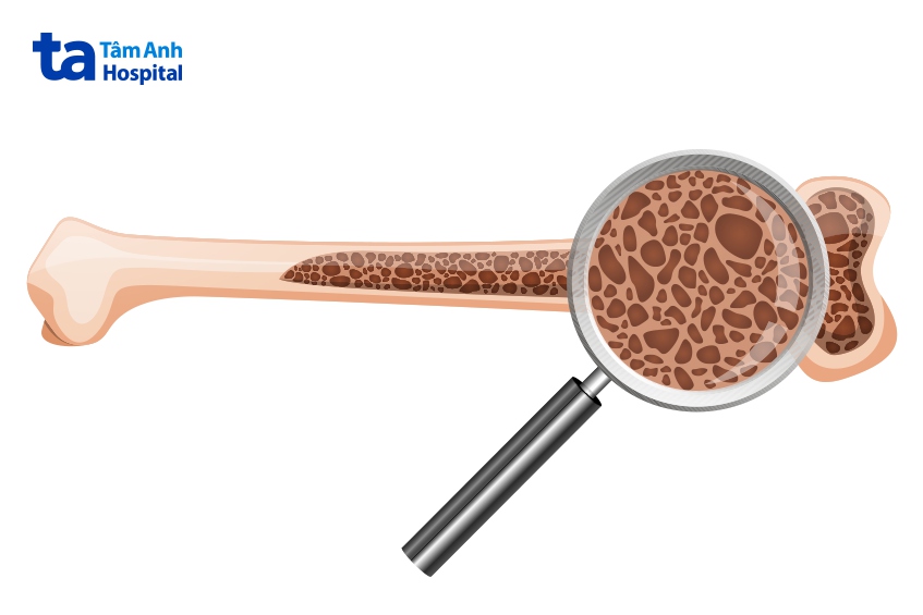 Loãng xương sau sinh cũng có thể khiến người mẹ bị gãy xương sườn khi sinh mổ