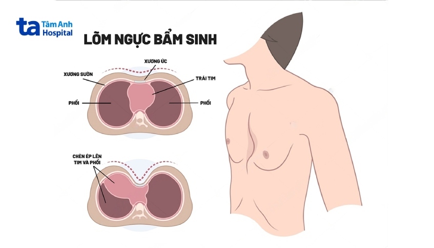 lõm ngực nặng có thể gây chèn ép tim, phổi