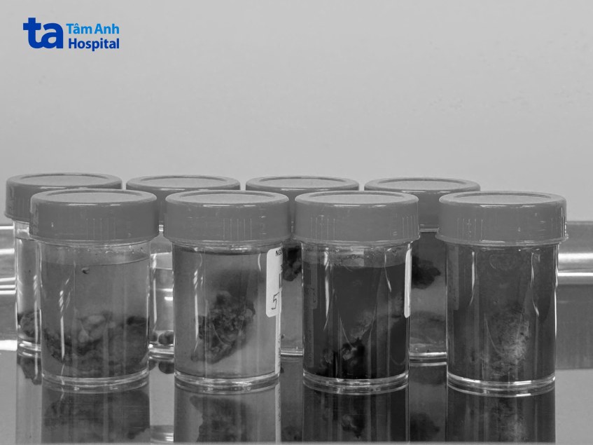 Lượng hạch được bác sĩ nạo để loại trừ tế bào ung thư