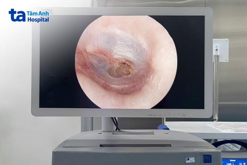 màng nhĩ bị thủng