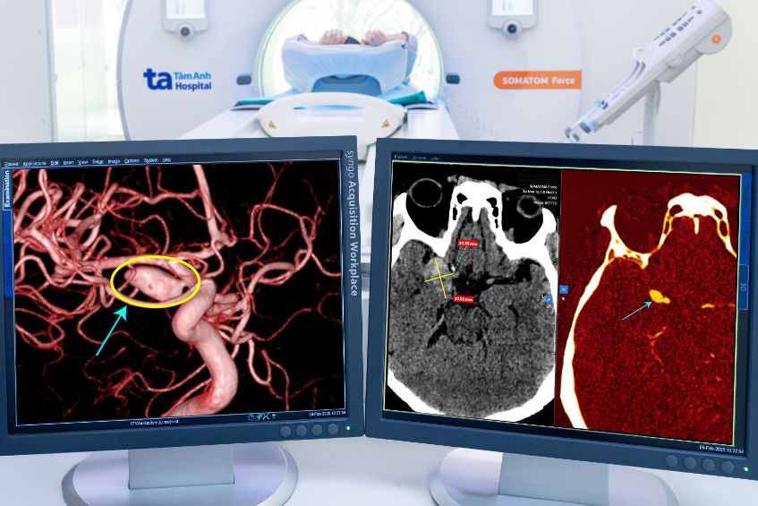 máy CT lát cắt siêu mỏng