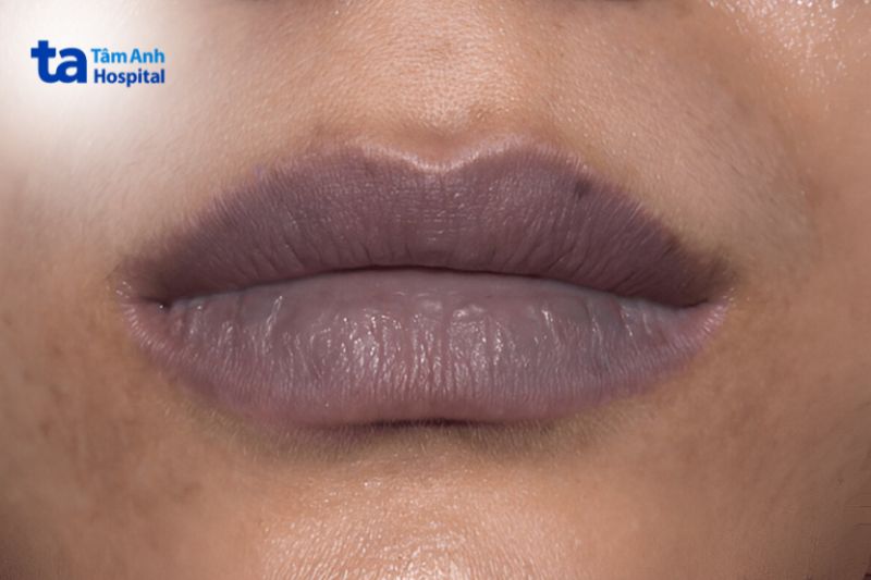 thâm môi do thiếu dưỡng chất có màu sẫm đen hơn