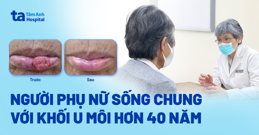người phụ nữ sống chung khối u 40 năm