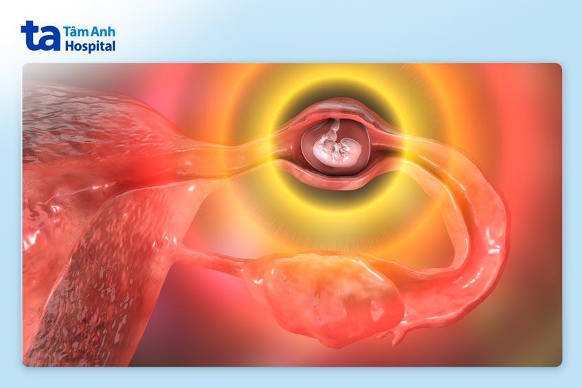 nguy hiểm khi mang thai ngoài tử cung