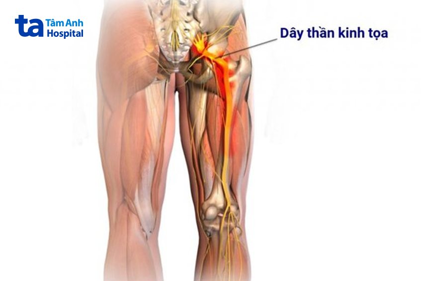 Nguyên nhân gây đau hông phổ biến