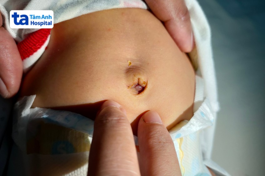 Hình ảnh nguyên nhân u hạt rốn ở trẻ sơ sinh