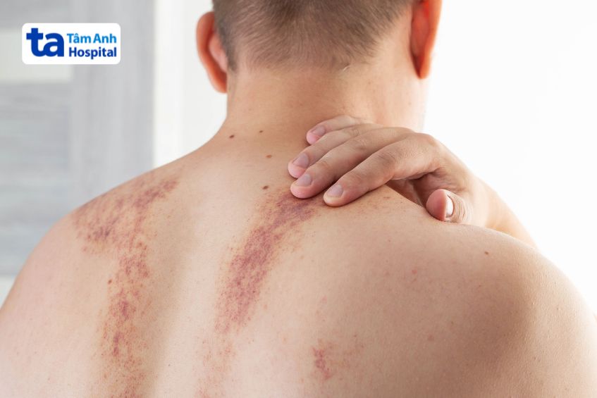 Những vết bầm lớn xuất hiện ở lưng