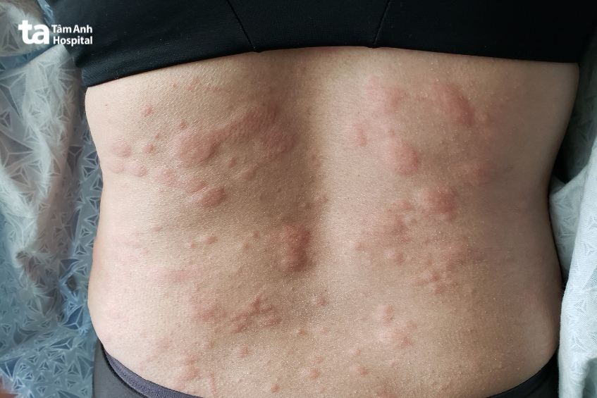 Nổi mề đay là triệu chứng dị ứng thường gặp