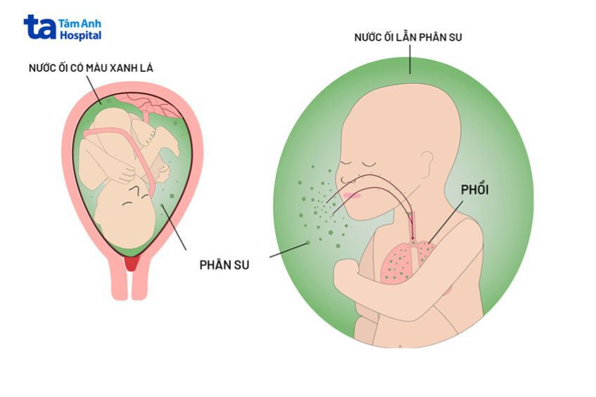 Nước ối màu xanh lá và nâu đậm là do thải phân su