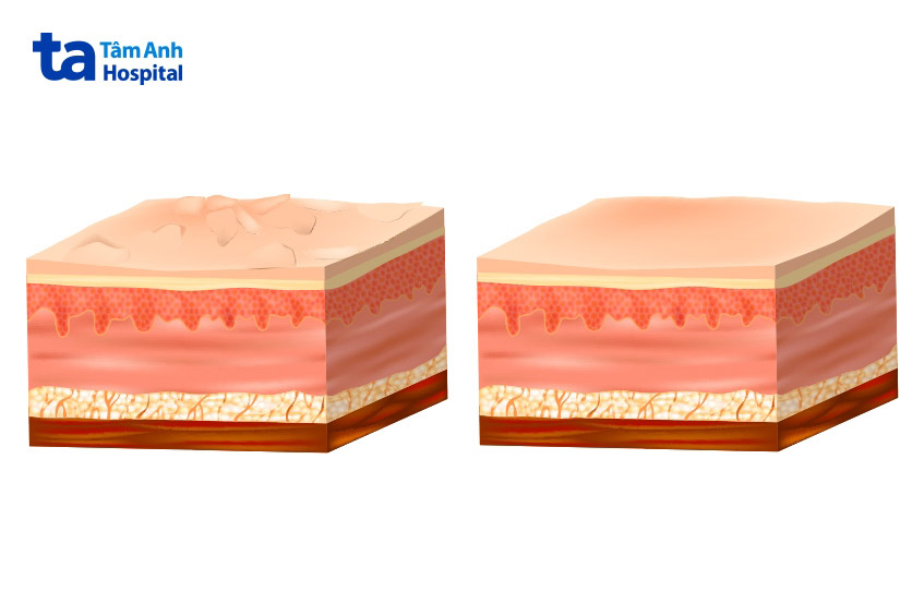 hình ảnh da trước và sau peel minh họa