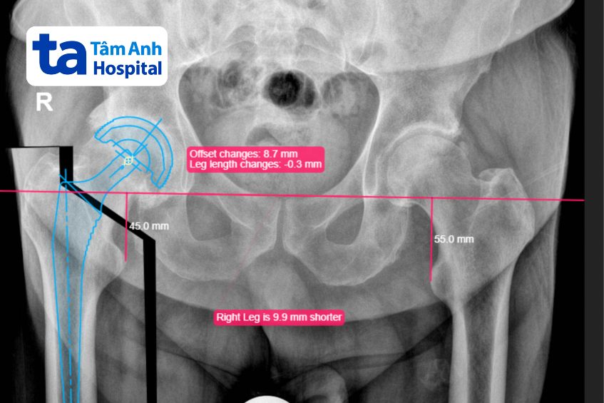 phần mềm traumacad tính toán loại khớp phù hợp