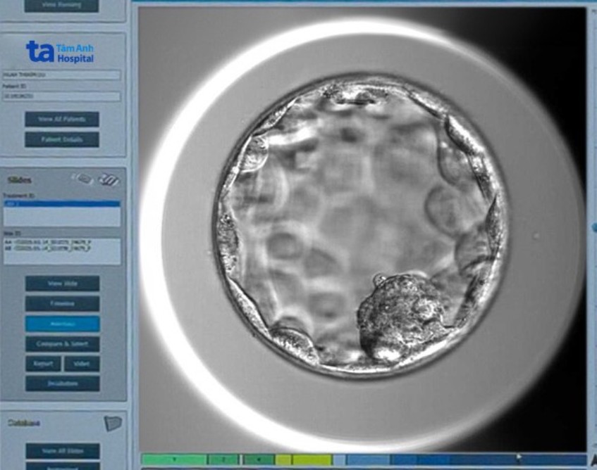Phôi ngày 5 chất lượng tốt và không mang bất thường di truyền được nuôi cấy tại IVF Tâm Anh