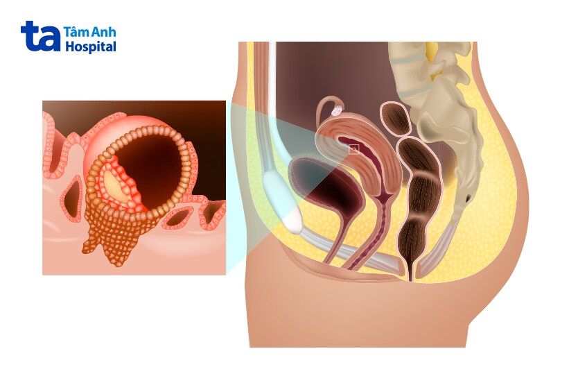 Phôi thai bám vào lớp niêm mạc tử cung gây ra hiện tượng máu báo thai nhẹ