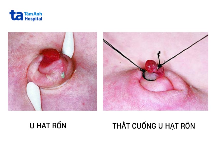 phương pháp điều trị u hạt rốn ít biến chứng