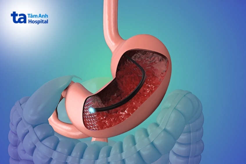 phương pháp nội soi dạ dày