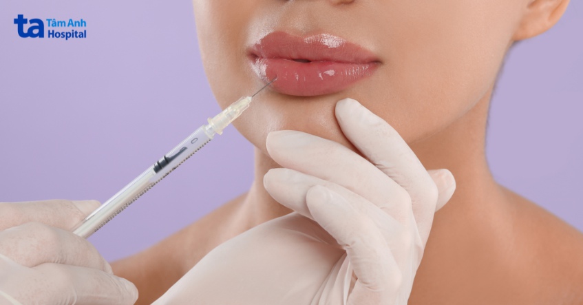 quá trình tiêm tan filler đơn giản và nhanh chóng
