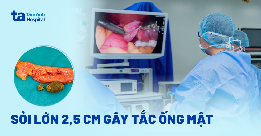 sỏi lớn 2,5cm gây tắc ống mật
