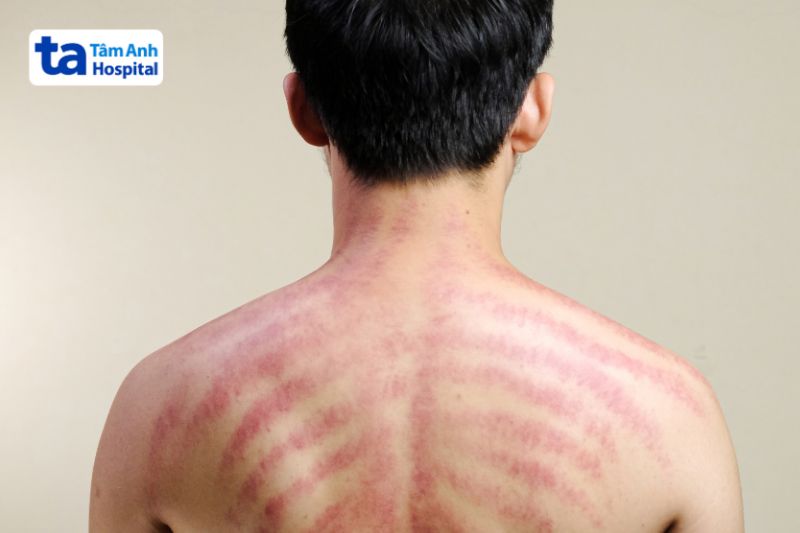 không nên cạo gió khi mắc bệnh sốt xuất huyết