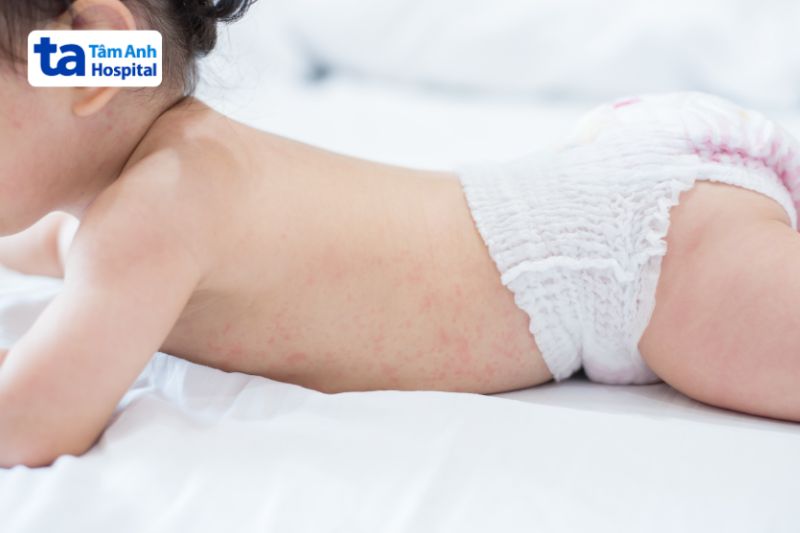 chấm xuất huyết là dấu hiệu gây bệnh ở trẻ