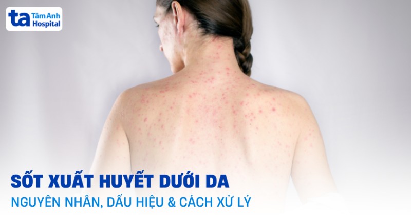 Sốt xuất huyết dưới da: Nguyên nhân, dấu hiệu và cách xử lý