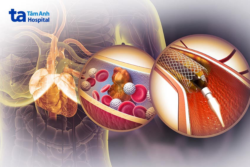 Stent động mạch cảnh khá đa dạng được phân chia thành nhiều loại với thiết kế và đặc tính vật lý đặc trưng