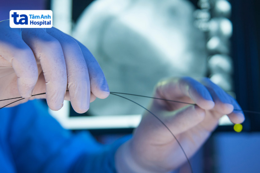 stent là một thiết bị kim loại nhỏ