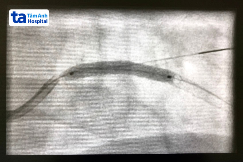 stent phủ thuốc được đặt vào cơ thể người bệnh