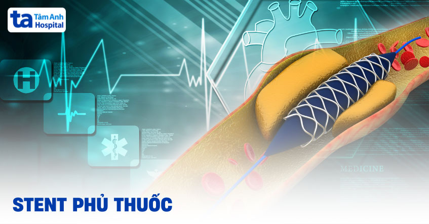 Stent phủ thuốc là gì? Tác động, độ an toàn và chi phí đặt