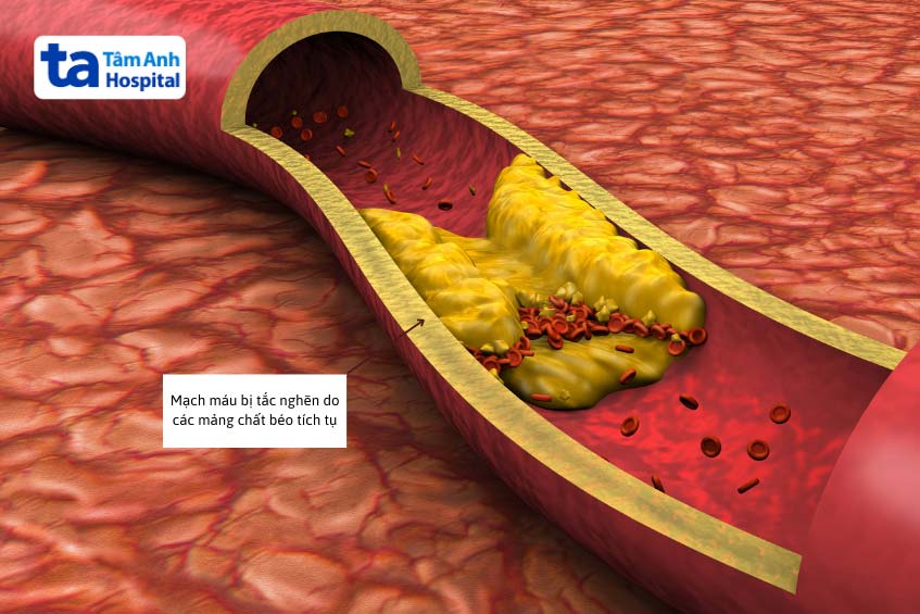 stent thông dòng chảy cho các mạch máu bị hẹp