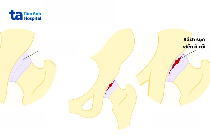 Sụn viền ổ cối bị rách