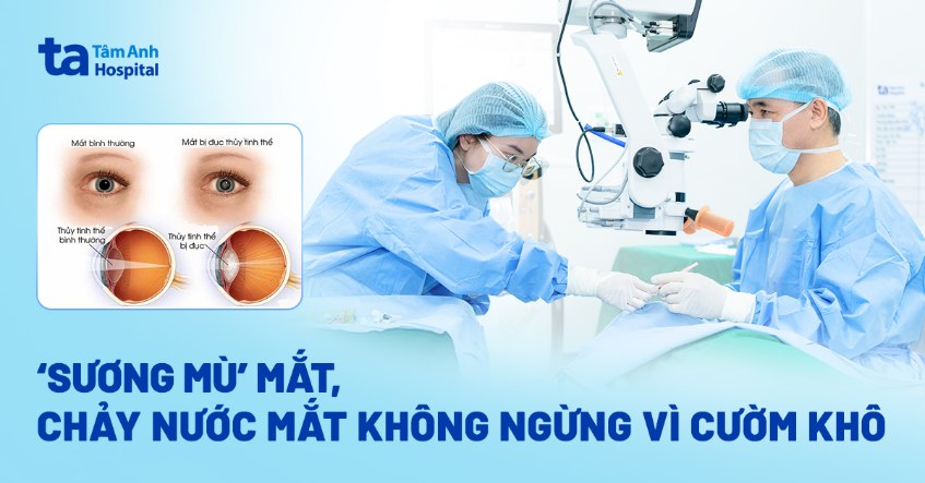 ‘Sương mù’ mắt, chảy nước mắt không ngừng vì cườm khô