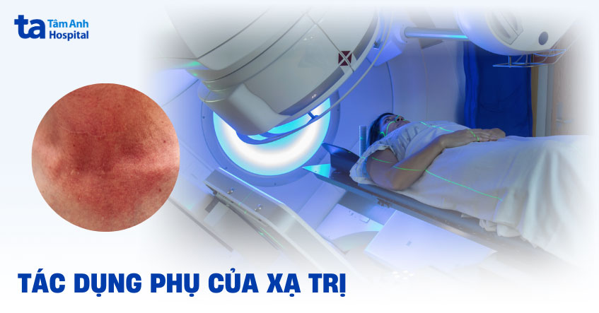 Các tác dụng phụ của xạ trị thường gặp