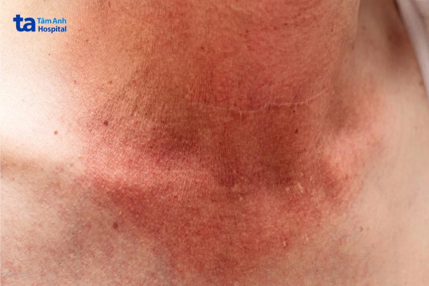 tác dụng phụ như rám da