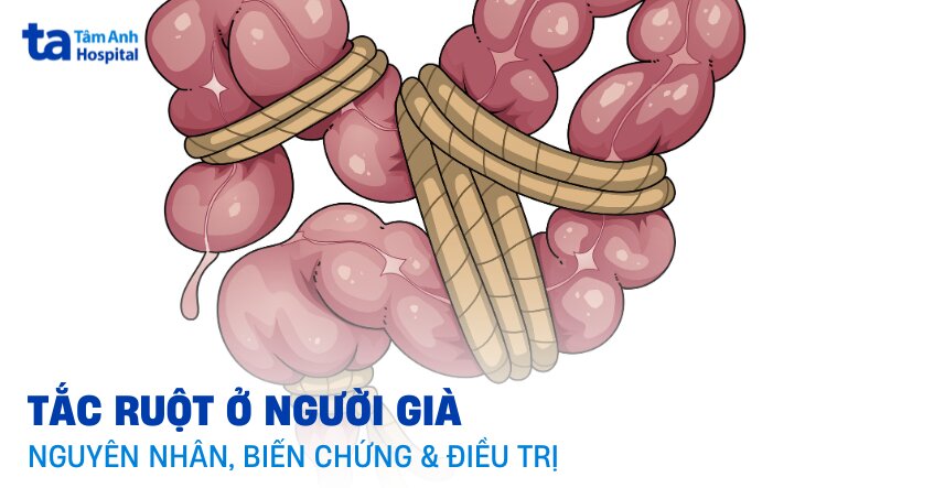 12 nguyên nhân tắc ruột ở người già và biến chứng rất nguy hiểm