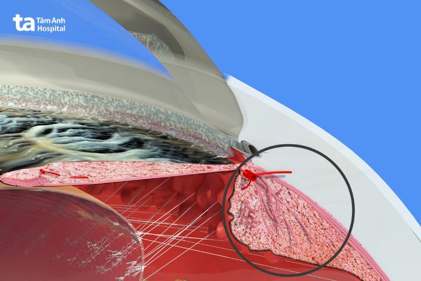 thể mi tiếp xúc với bộ phận mắt khác