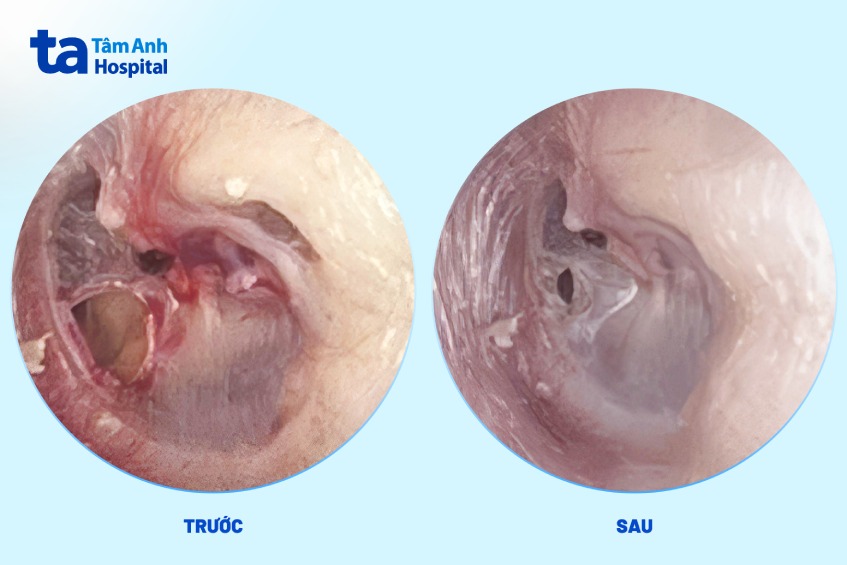 thủng màng nhĩ do va chạm