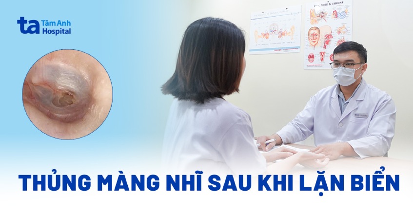 thủng màng nhĩ sau khi lặn biển