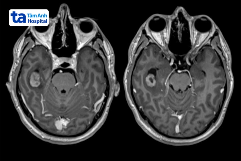 tổn thương não ở vùng đỉnh trán