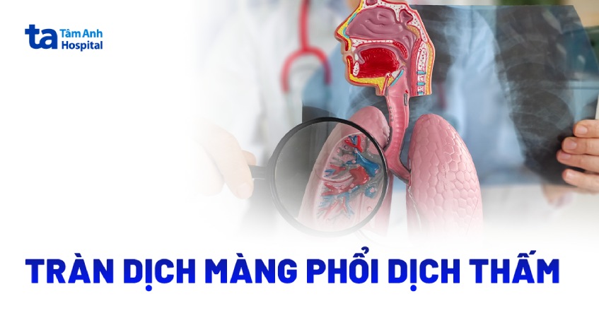 Tràn dịch màng phổi dịch thấm trị được không? Nguyên nhân vì sao?