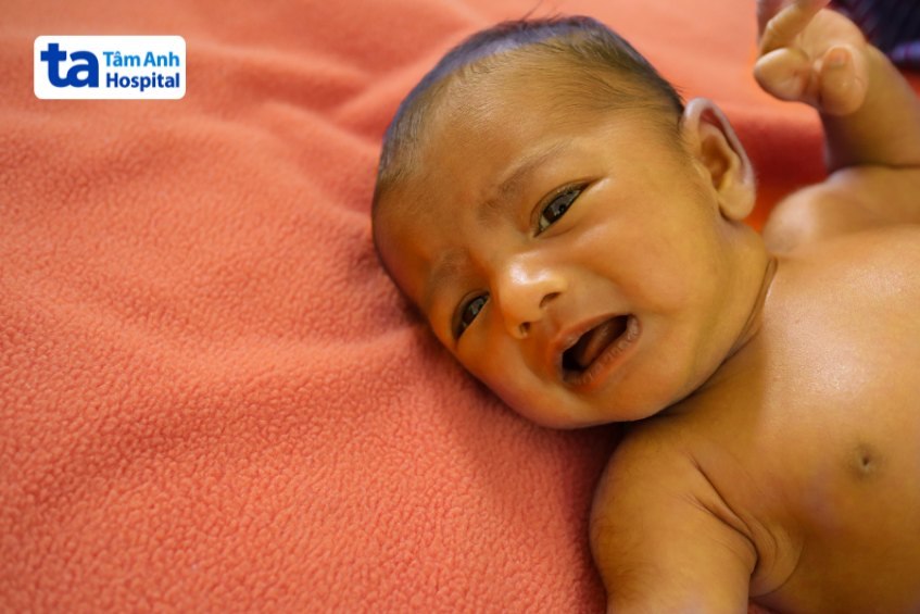 Trẻ bị vàng da có thể là dấu hiệu của bệnh ứ mật sơ sinh