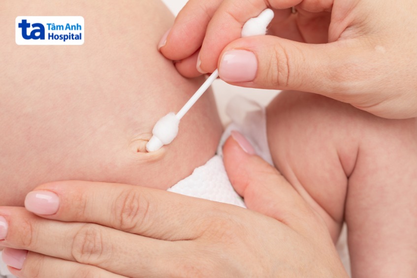 trẻ sau đốt điện u hạt rốn cần được chăm sóc đúng cách